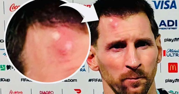 Messi sưng vêu trán sau trận thắng Cabo Verde: Vì sao nên nỗi? - hình ảnh - sc88go.com